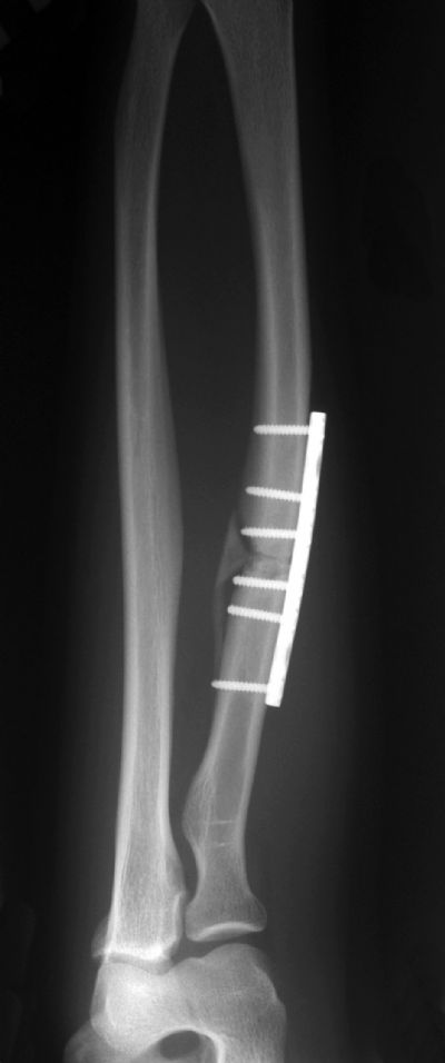 Radius & Ulna, Shaft:  Synthes DCP (Implant 263)